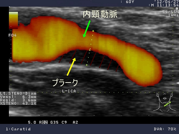 プラークとは