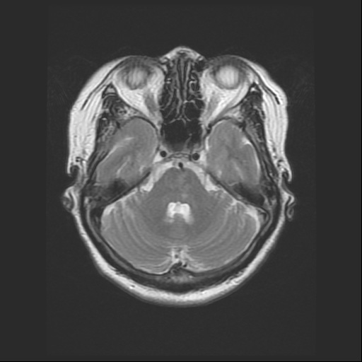 MRI画像（脳梗塞）