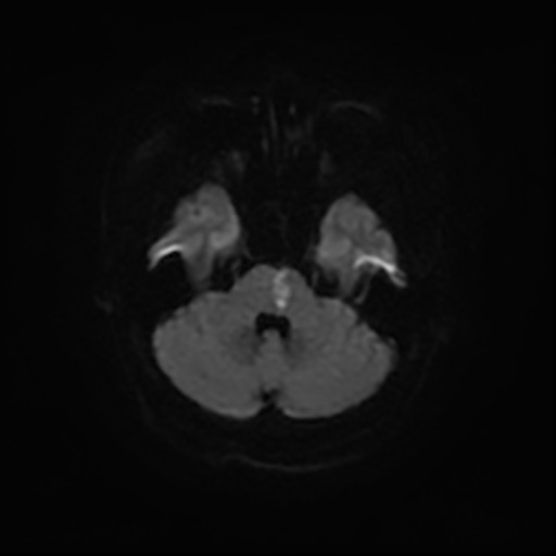 MRI画像（脳梗塞）